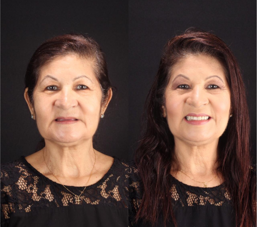 Antes e Depois de Antonia Maria, que realizou implantes dentários na Ianara Pinho em Brasília