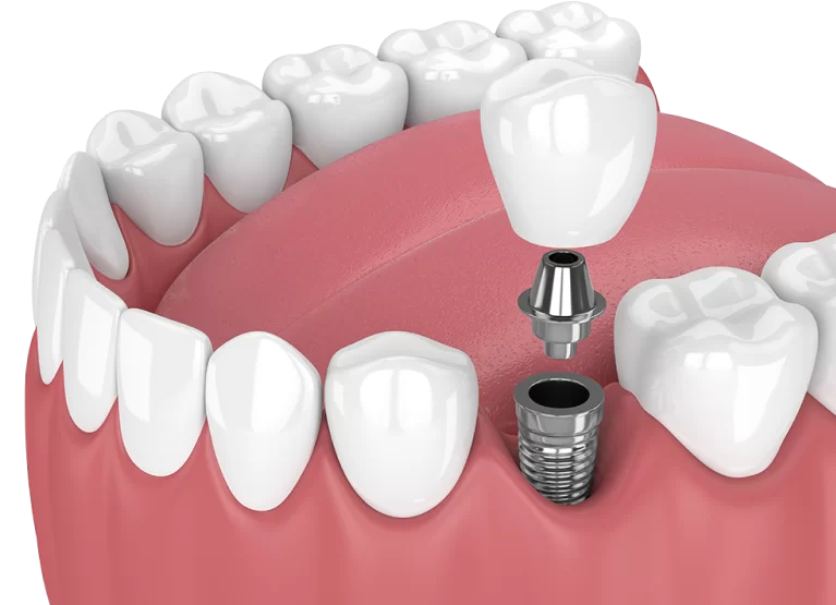 Implante Dentário em Águas Claras e Asa Sul