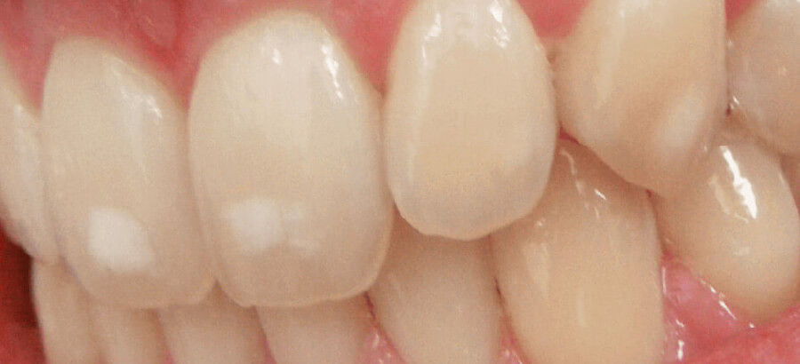 Fluorose dentária: o que você precisa saber