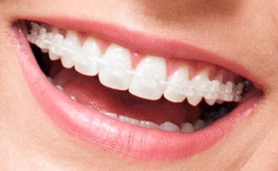 fotos de aparelhos de dentes transparentes aparelho fixo transparente estético
