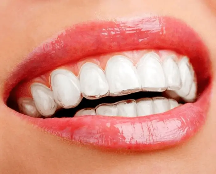 fotos de aparelhos de dentes transparentes alinhador estético invisível