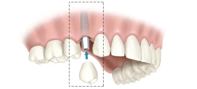 tipos de implantes dentarios fotos