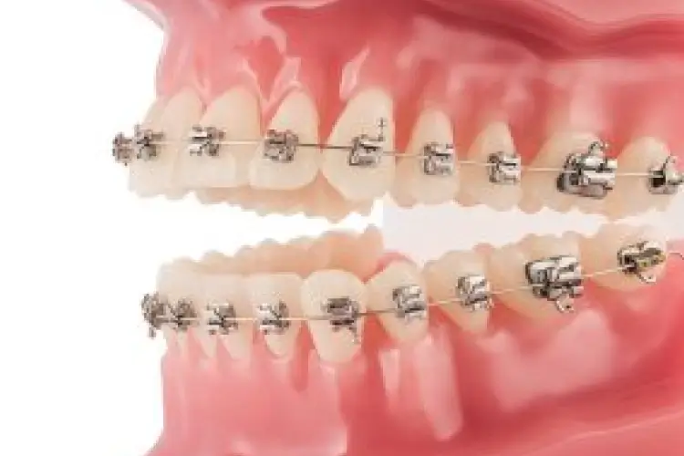 Aparelho ortodôntico autoligável metálico aplicado nos dentes superiores e inferiores