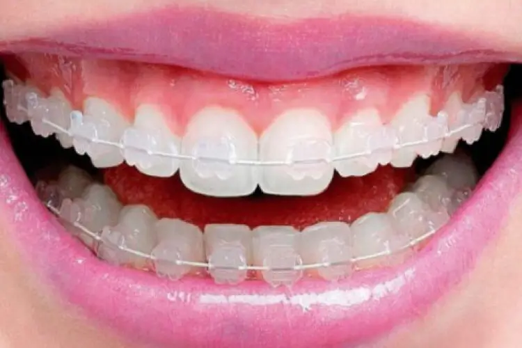 Aparelho ortodôntico de porcelana com bráquetes estéticos transparentes