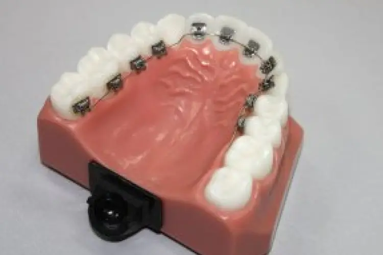 Aparelho ortodôntico lingual instalado na parte interna dos dentes superiores