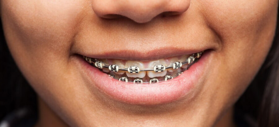 Criança usa aparelho ortodôntico para evitar problemas dentários futuros.