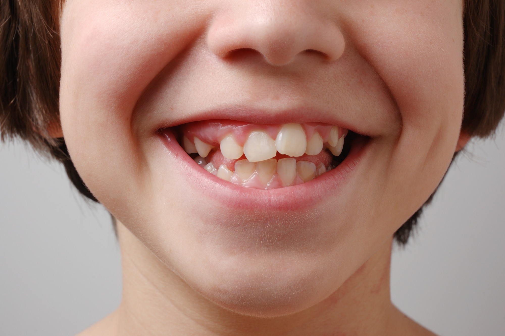 Saiba os problemas causados pelos dentes desalinhados e como tratar