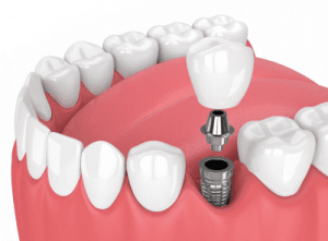 Como é realizado o implante dentário