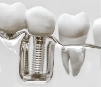 implante dentário fotos