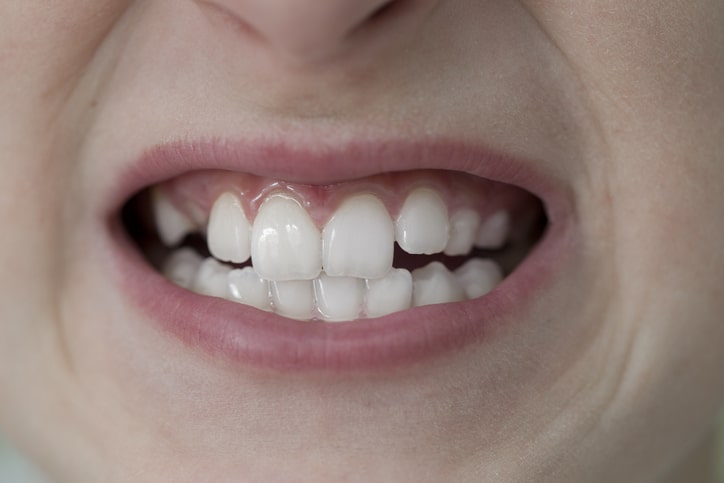 Os 3 tipos de dentes tortos e problemas de mordida mais frequentes