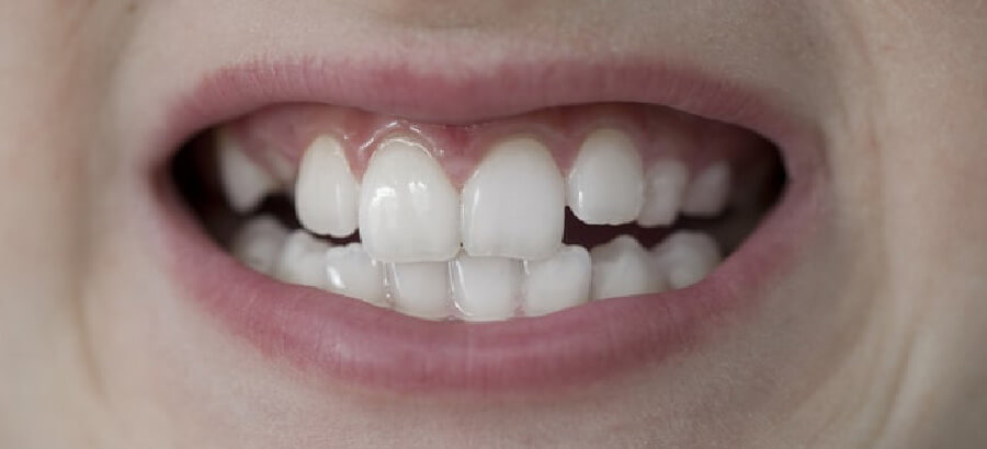 tipos de dentes tortos