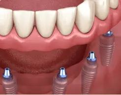 tipos de implante dentário fotos