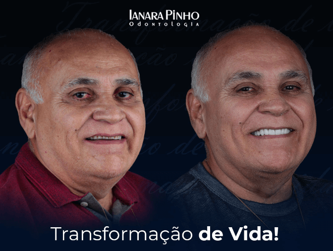 Comparativo Antes e Depois em procedimento de lentes de contato dental em homem na Clínica Ianara Pinho