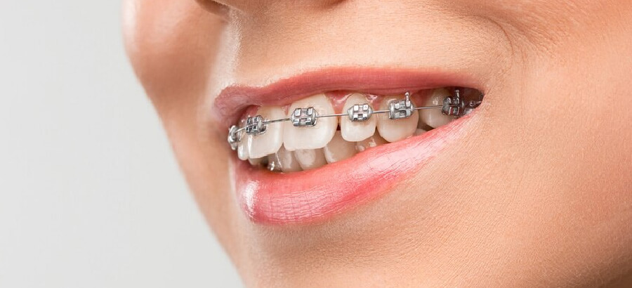 Ortodontia: O que é e porque realizar esse tratamento ortodôntico