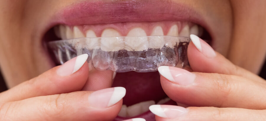 Clareamento Dental Com Moldeira – Tire Todas As Suas Dúvidas