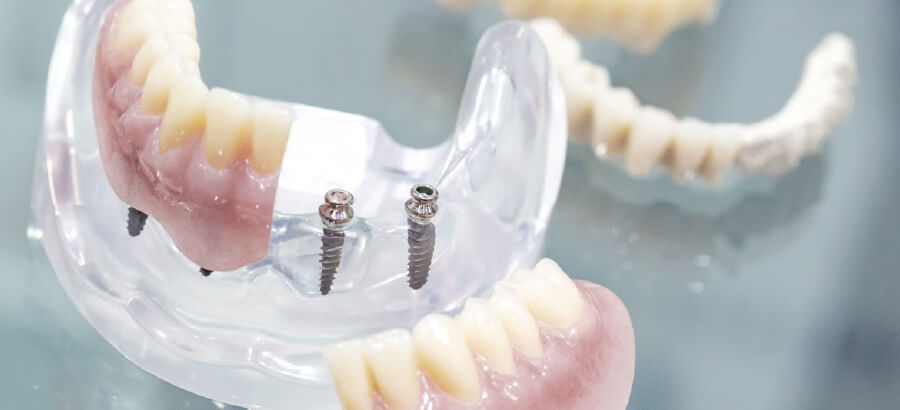 Mini-Implante Dentário: para que serve e como funciona?