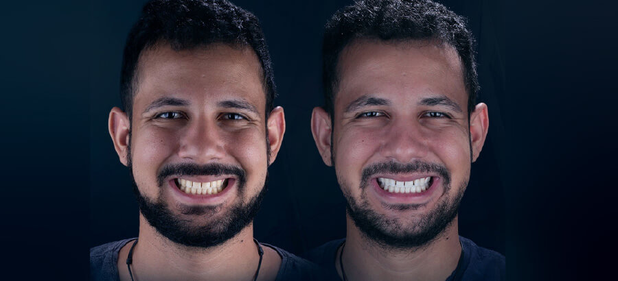 Clareamento Dental Antes e Depois