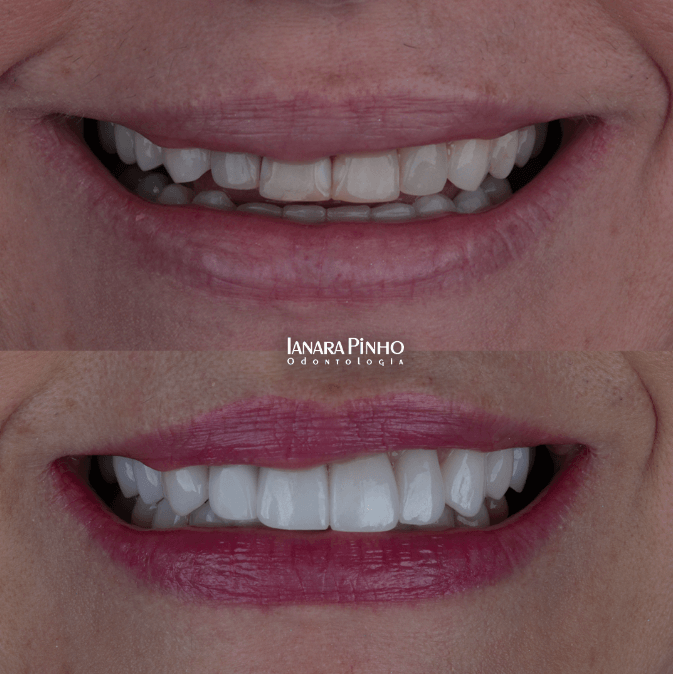 Lente de Contato Dental Antes e Depois | Ianara Pinho Odontologia