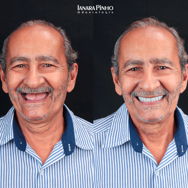 antes e depois de reabilitação de prótese protocolo realizado pela Ianara Pinho em senhor