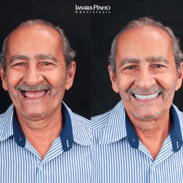 antes e depois de reabilitação de prótese protocolo realizado pela Ianara Pinho em senhor