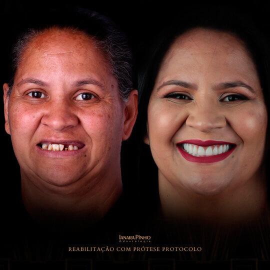 antes e depois de reabilitação de prótese protocolo realizado pela Ianara Pinho em senhora