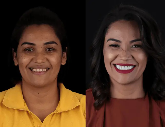 Comparativo Antes e Depois em procedimento de lentes de contato dental em mulher na Clínica Ianara Pinho