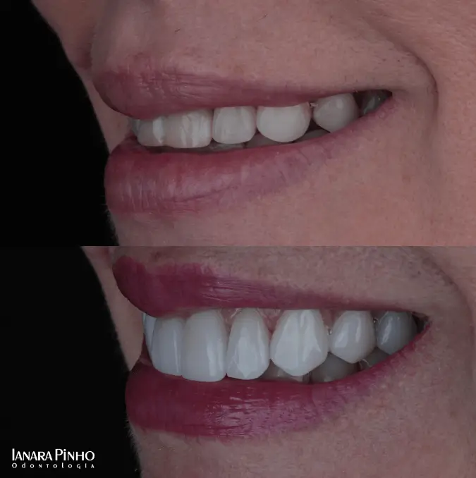 Comparativo Antes e Depois em procedimento de lentes de contato dental em mulher na Clínica Ianara Pinho
