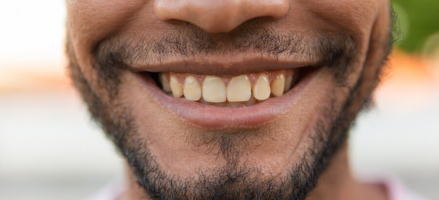 Dentes amarelados: o que pode ser e como reverter?