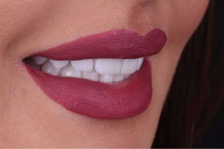 Detalhe de um sorriso após a colocação de facetas de porcelana