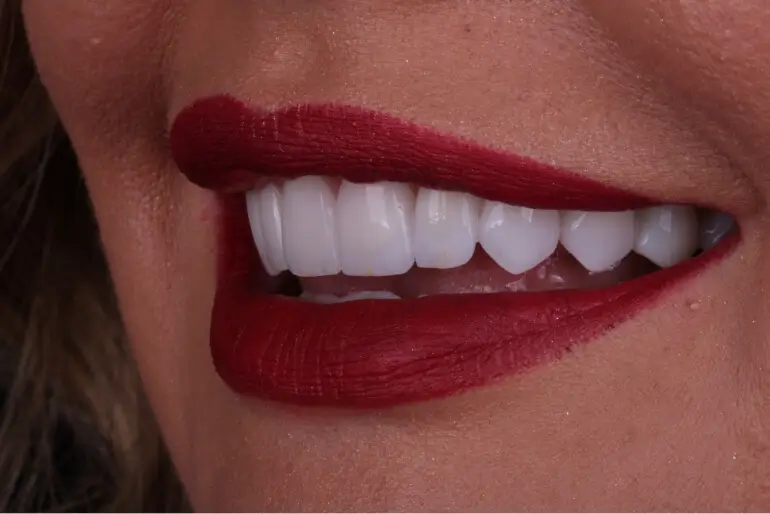 Detalhe de outro sorriso após a colocação de facetas de porcelana
