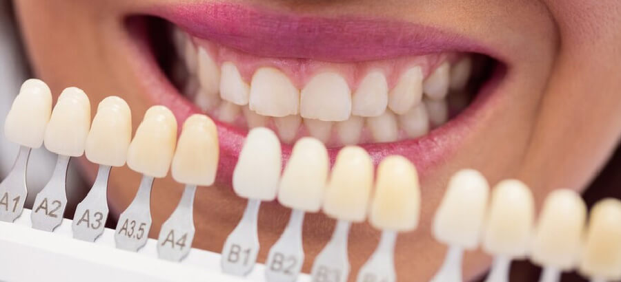Tudo o que você precisa saber sobre clareamento dental