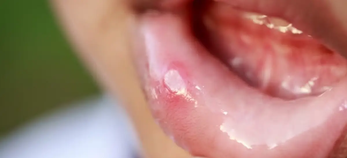 Close-up de úlcera na mucosa oral, característica da mucosite, com área avermelhada e inflamada