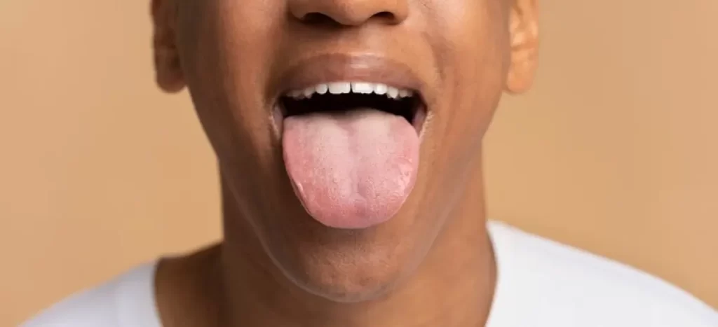 Saliva Doce: o que é, quais as causas e quando procurar um dentista