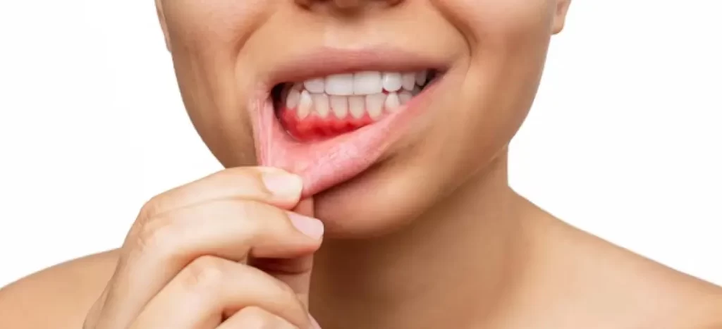 Gengivite: o que é, quais são os sintomas e como identificá-la