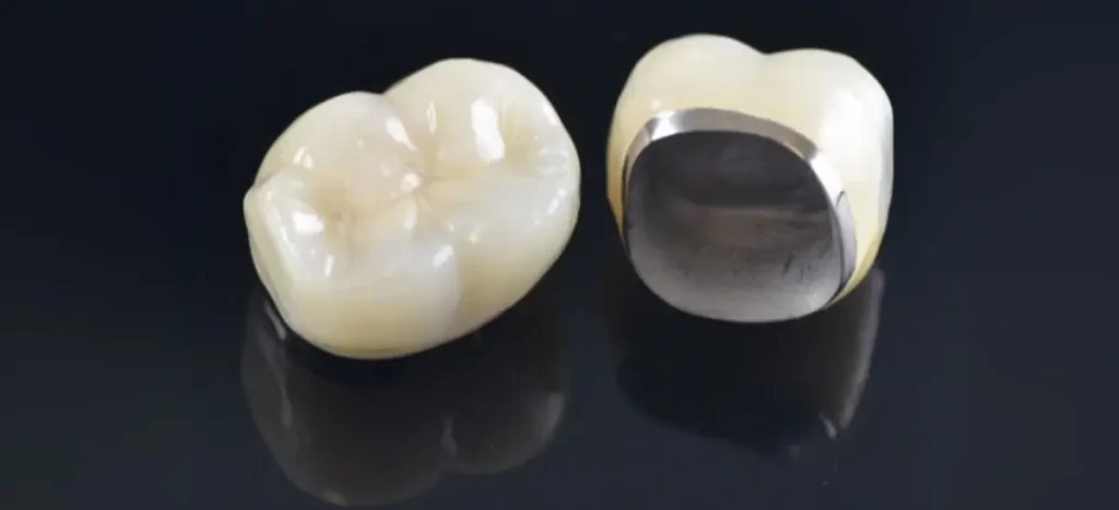 Coroa metalocerâmica: tudo o que você precisa saber sobre