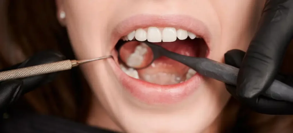 Reabsorção radicular: o que é, causas, tipos, sintomas e tratamento