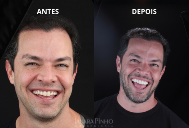 Comparativo de sorriso antes e depois das facetas dentárias