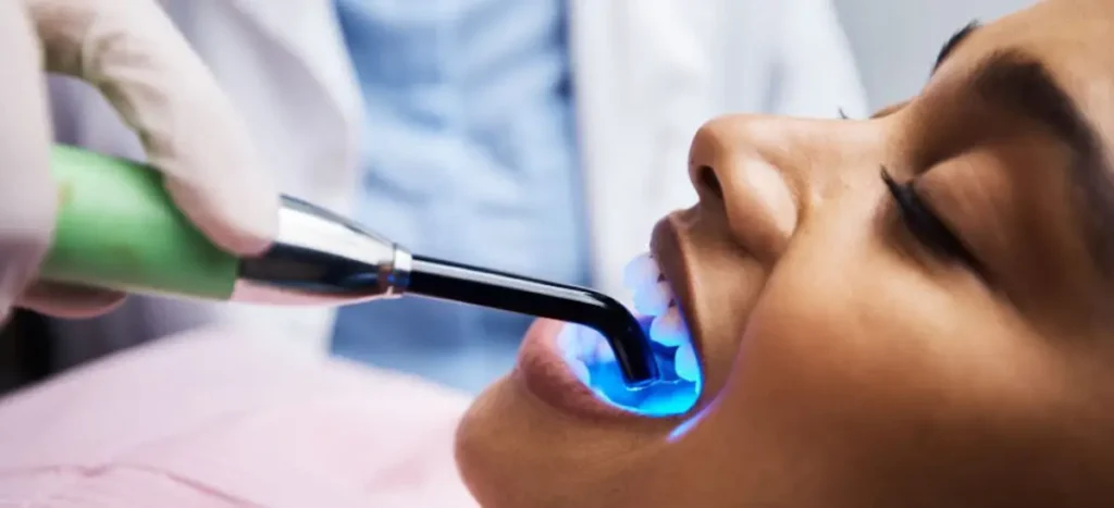 Selante dental: o que é, benefícios, aplicação, duração e custos