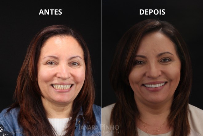 Paciente antes e depois do tratamento odontológico com facetas dentárias