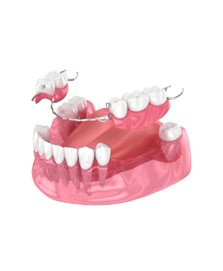 Exemplo Ilustrativo de uma prótese dentária