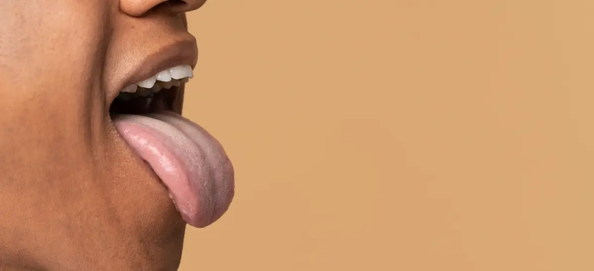 Língua estendida mostrando alterações visíveis associadas ao câncer de língua