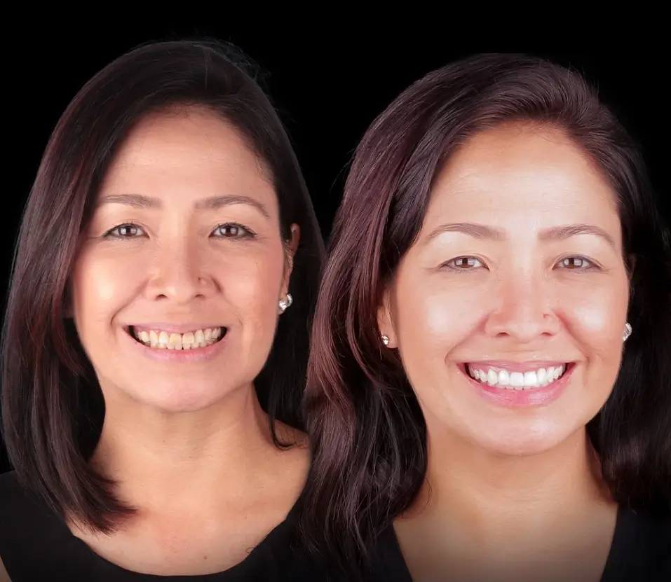 Procedimento de levantamento de seio maxilar em Brasília DF