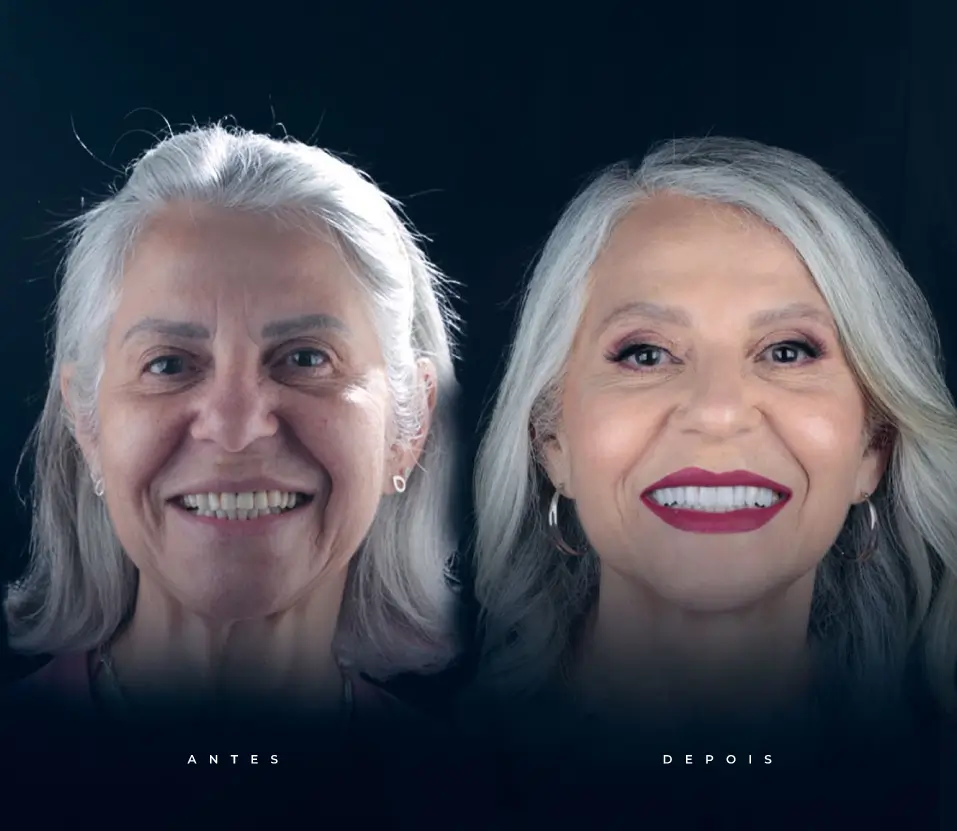 Paciente idoso sorrindo ~em uma imagem de antes e depois após tratamento de reabilitação oral