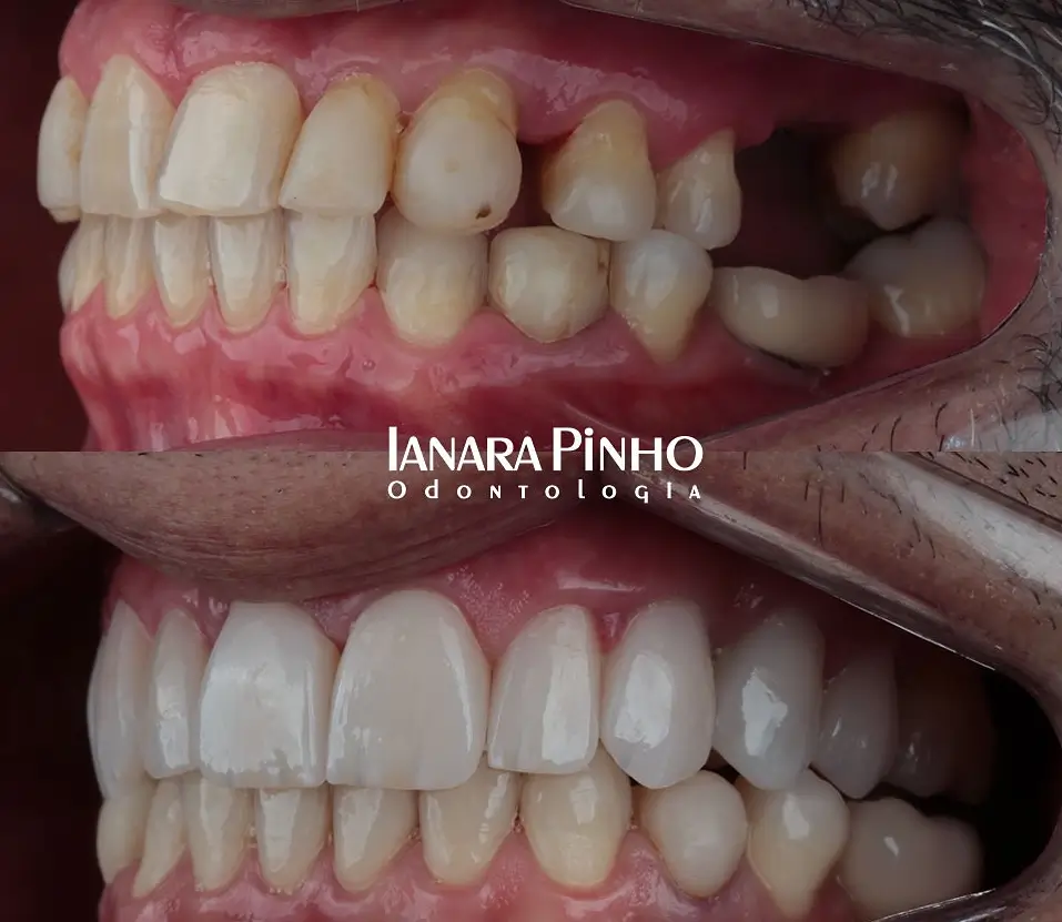 Paciente após enxerto gengival em Brasília DF