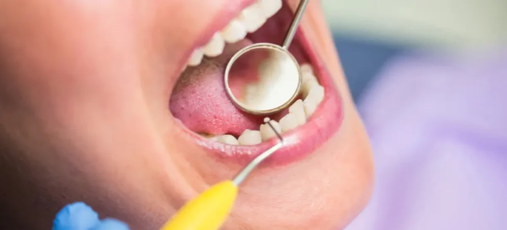 Buraco no dente: causas, sintomas e tratamentos para cuidar da sua saúde bucal