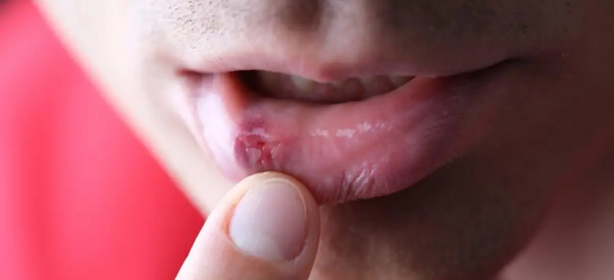 Ferida no lábio causada por herpes labial, sintoma comum da infecção