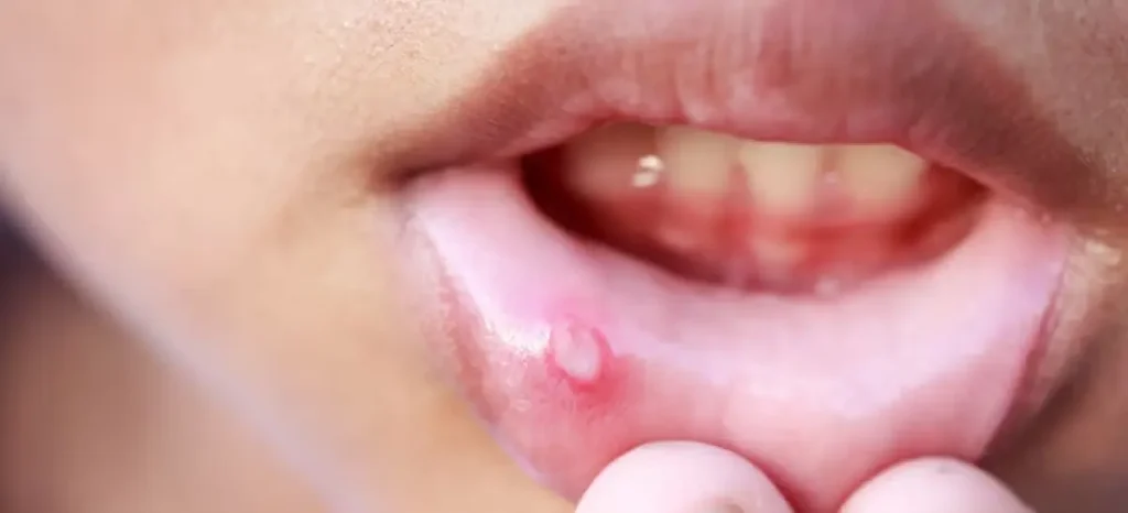 Mucocele na boca: o que é, as causas, os sintomas e como tratar