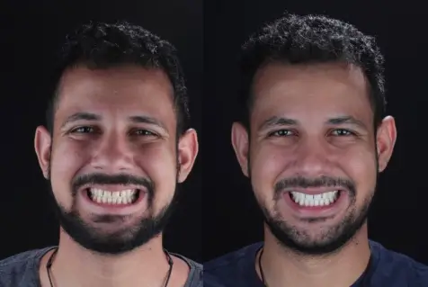 Clareamento dental antes e depois