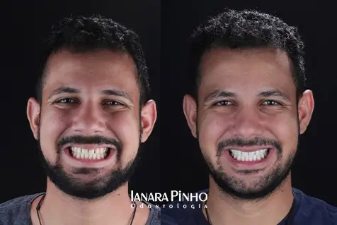 Imagem mostra antes e depois de realizar Clareamento dental na Ianara Pinho Odontologia