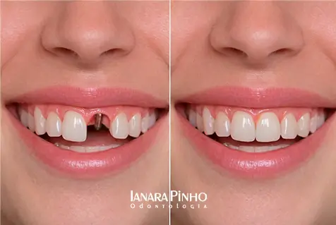Imagem mostra antes e depois de realizar Implante dentário unitário na Ianara Pinho Odontologia